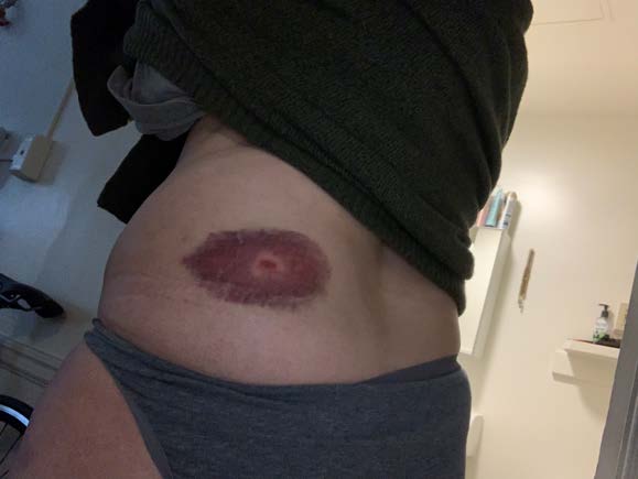 Picture of large bruise on lower left back/upper hip