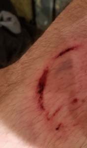 Picture of large bruise 2