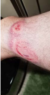 Picture of several bruises on leg - Slightly bloody