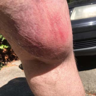 Picture of swollen, bruised, red welt on leg