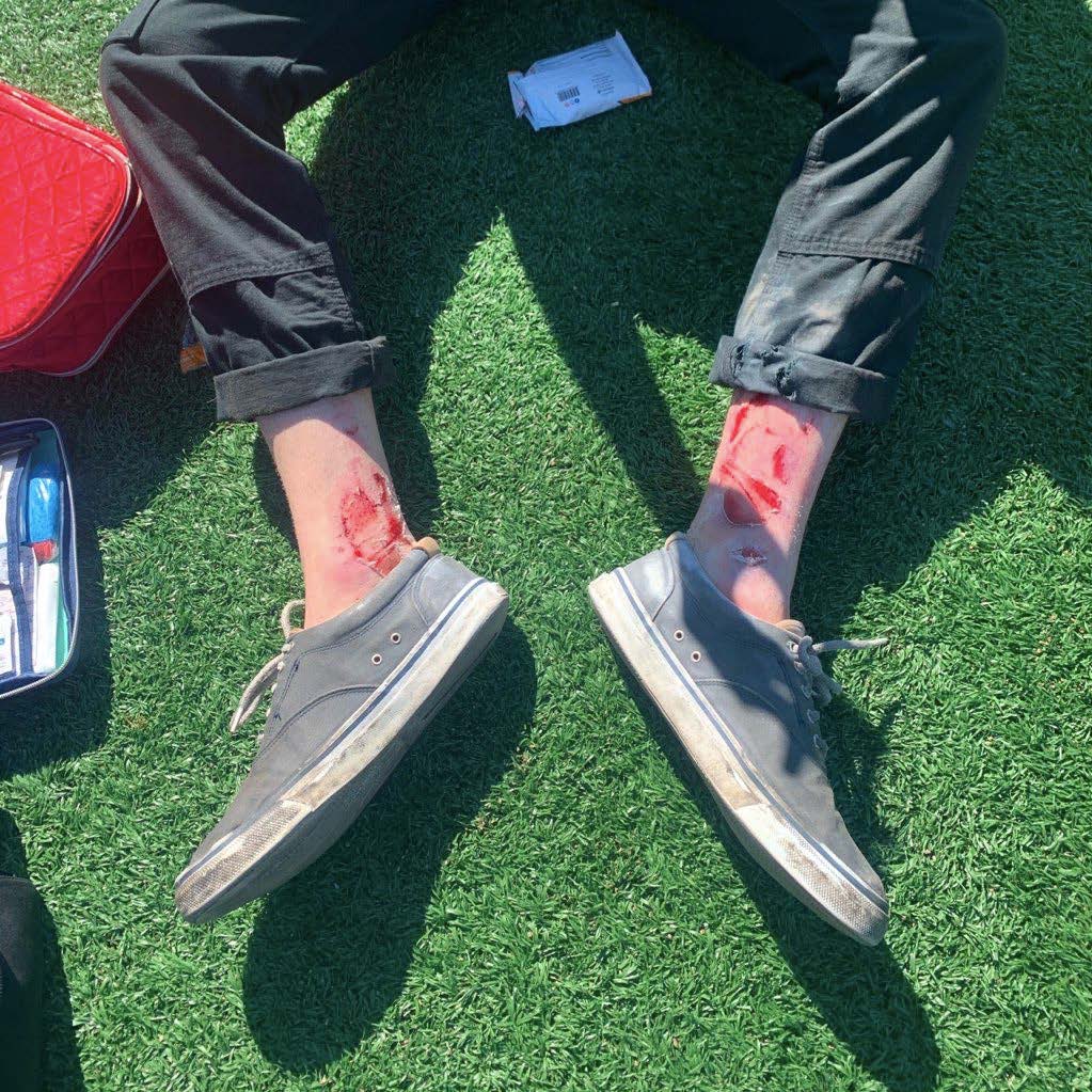 Picture of ankle injury taking with shoes on