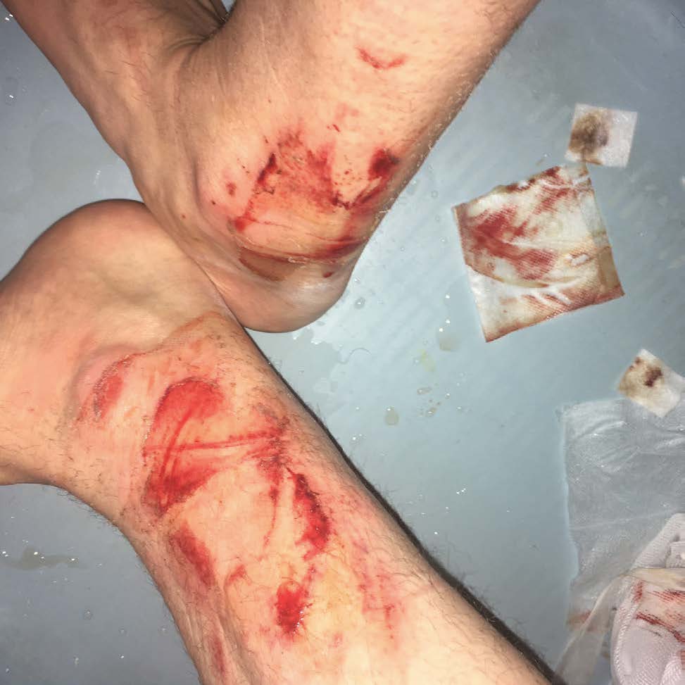 Picture of ankle injury 3