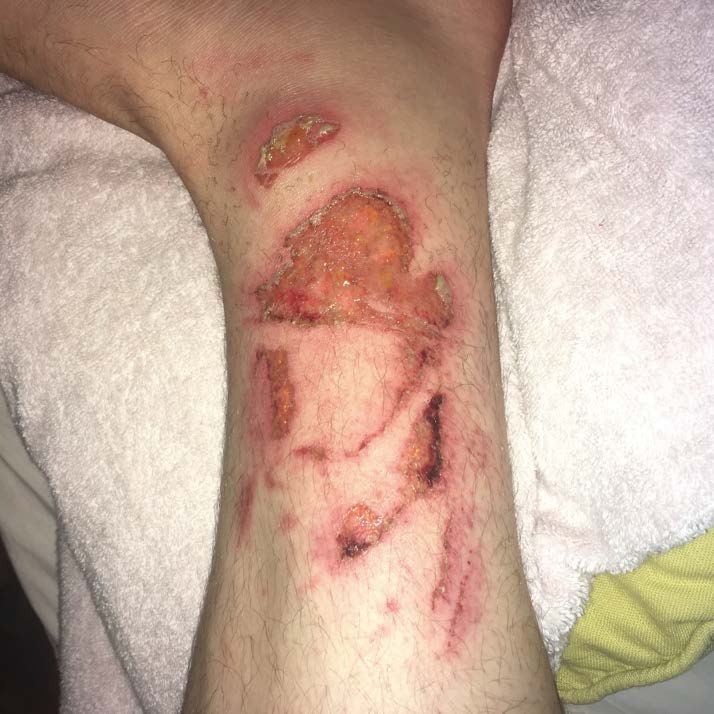 Picture of ankle injury 2