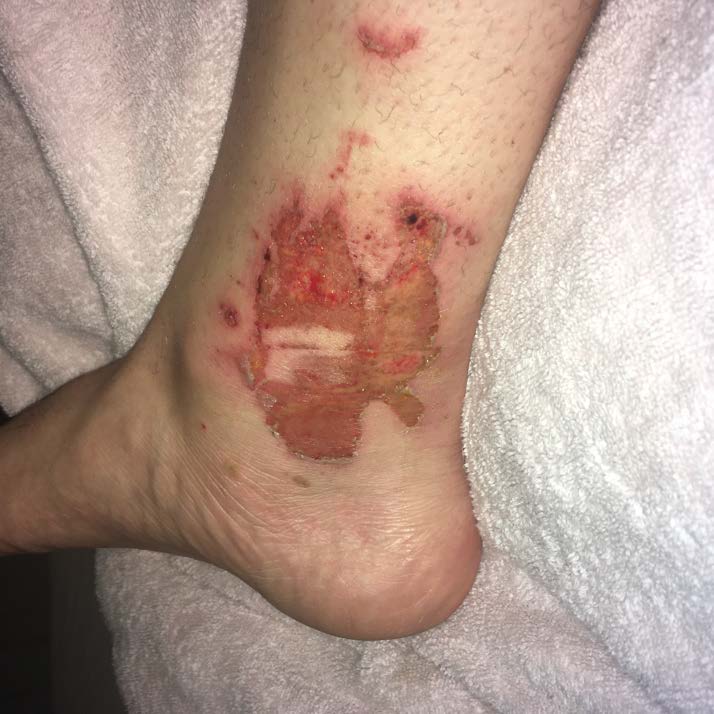 Picture of ankle injury 5