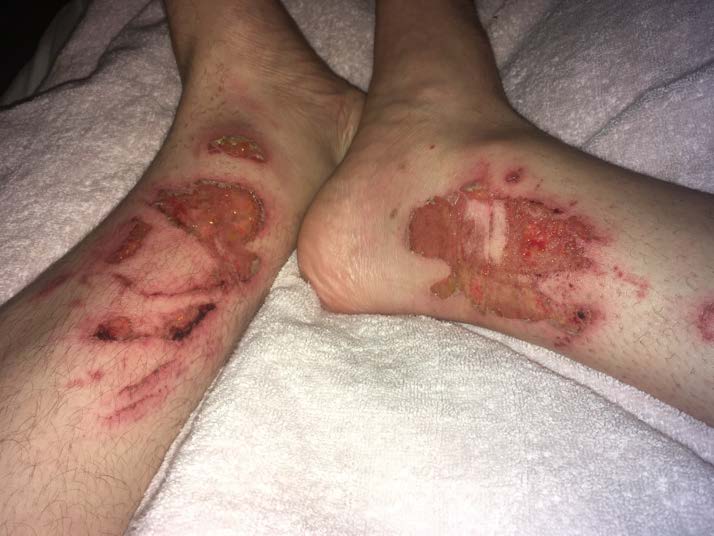 Picture of ankle injury 4