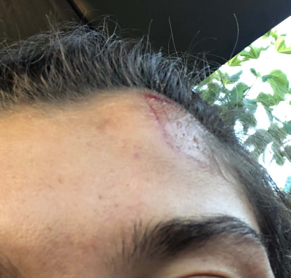 Zoomed in picture of bruised welt on top left temple of a face