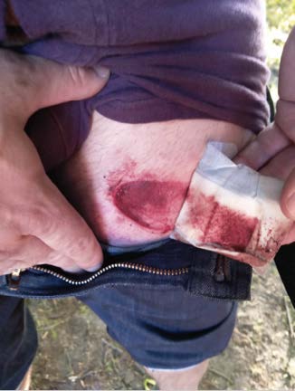 Picture of somebody peeling back a bandage to reveal a bloody welt on upper front part of leg