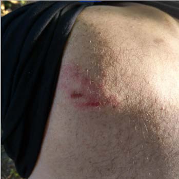 Picture of a person lifting up a shirt to reveal a bruise on upper left back