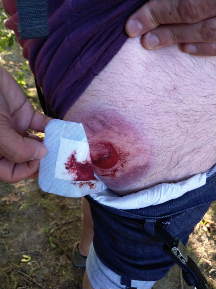 Close-up of a person peeling back a bandage to reveal a bloody welt on upper leg