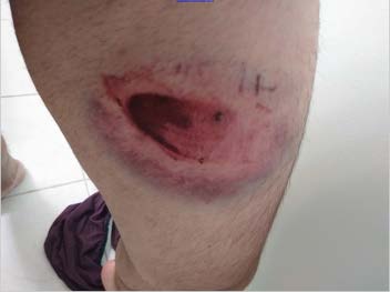 Close-up of large bloody welt on upper left thigh