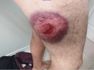 Close-up of large bloody welt on upper right thigh
