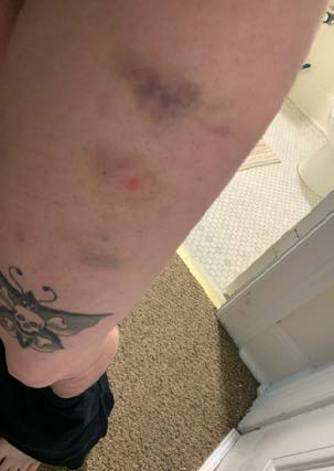 Picture of several bruises on upper left thigh