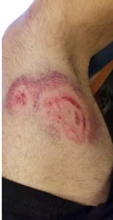Picture of large bruise 2
