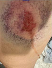 Bruise caused by blast ball 2