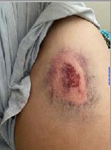 Closeup of bruise caused by blastball.