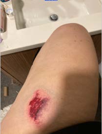 Bruise caused by blast ball 2