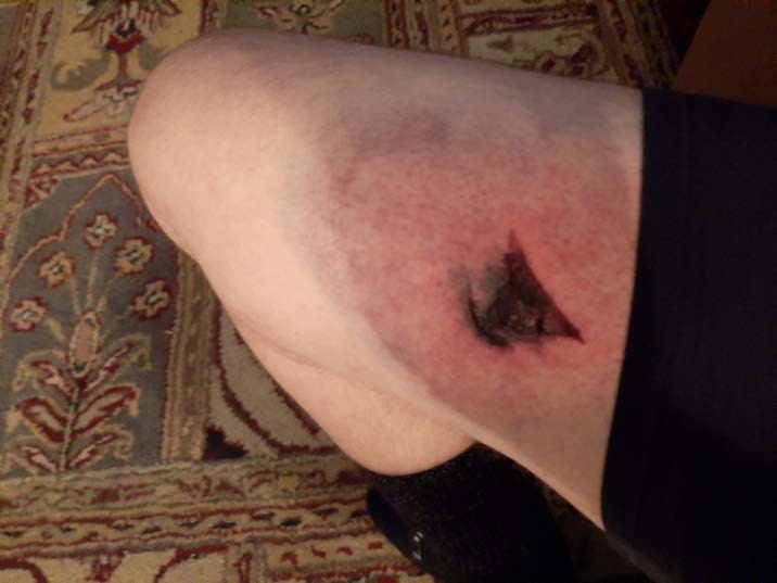 Blast ball injury to the thigh