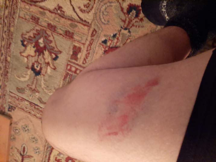 Blast ball injury to the thigh 2