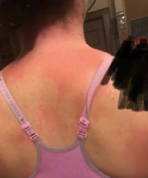 Picture of skin irritation