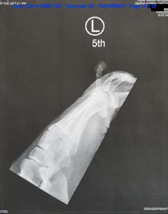 X-ray image of broken toe