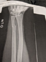 X-ray of arm, showing a fracture