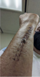 Image of victim's arm after surgery