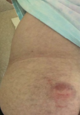Picture of bruise