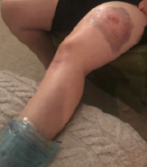 Picture of large bruise on left thigh