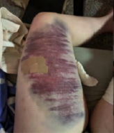 Bruise covering whole inner thigh