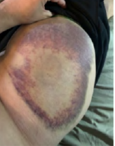 Bruise covering whole hip