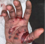 Hand lacerations, blood and swelling