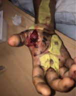 Skin grafts on injured hand