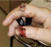 Lacerations on swollen, bleeding hand