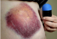 Massive bruise on leg