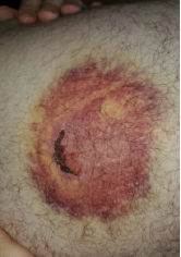 Bruise with laceration