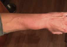 Severely swollen wrist